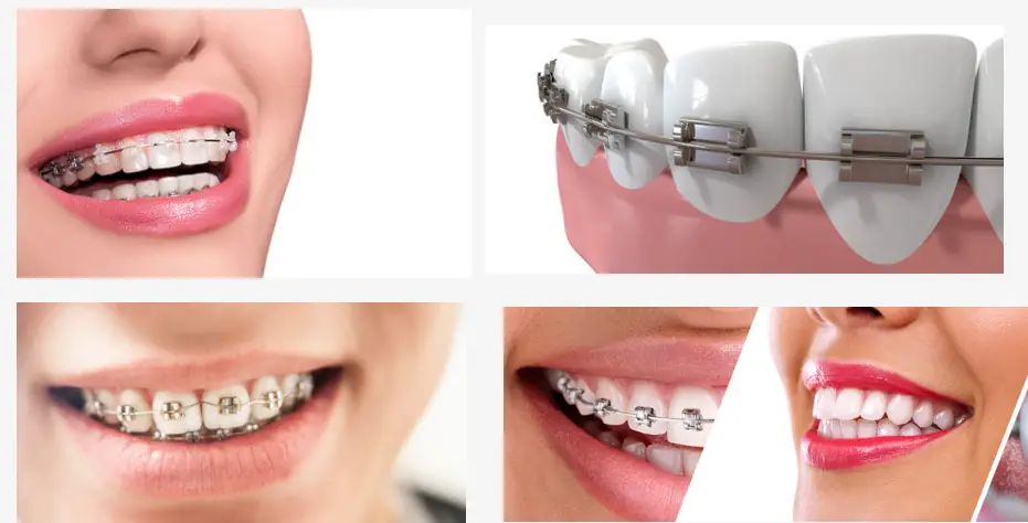 Cost of Braces in Nigeria (September) 2021 | LewisRayLaw